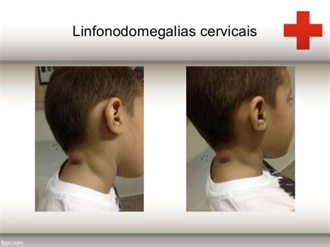 linfonodomegalia cervical em crianças